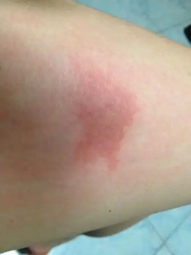 皮肤疑似被什么虫子咬了,已经四天了,依旧那么红,触摸的话可以感觉到