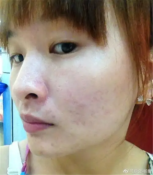 红血丝敏感肌必点