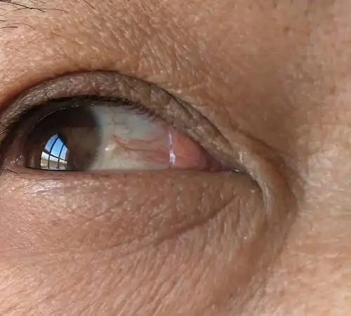 白眼球上有个芝麻大小的白疙瘩,如图.这是什么病?需要去医院吗?