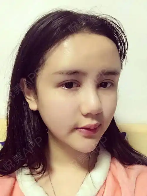 面部填充术后4天_自体脂肪术后4天_一只鸽子分享图片3