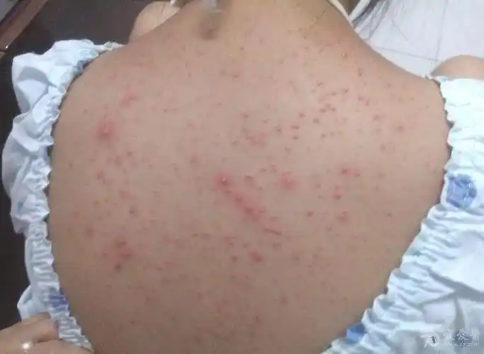 为什么天气变冷后背毛囊炎(天气炎热后背毛囊发炎红肿痘痘怎么办)