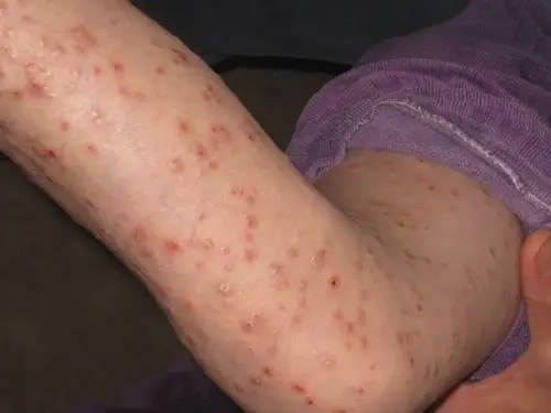 69 皮肤及性传播疾病讨论版 69 女孩你受罪了,有人见过这样的疮吗