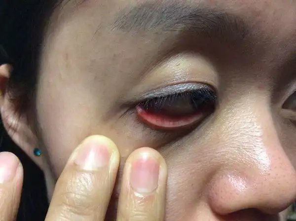 你好,我右边下眼皮里面长了个小疙瘩,不知