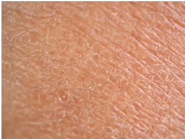 角质层无法正常代谢时,老废角质会堆积在皮肤表面,导致皮肤纹理粗大