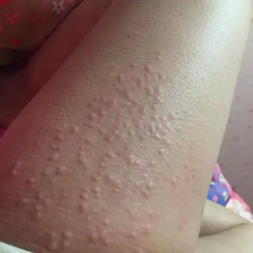 孕35周身上出了小疙瘩,很痒,特别是晚上,不知道是
