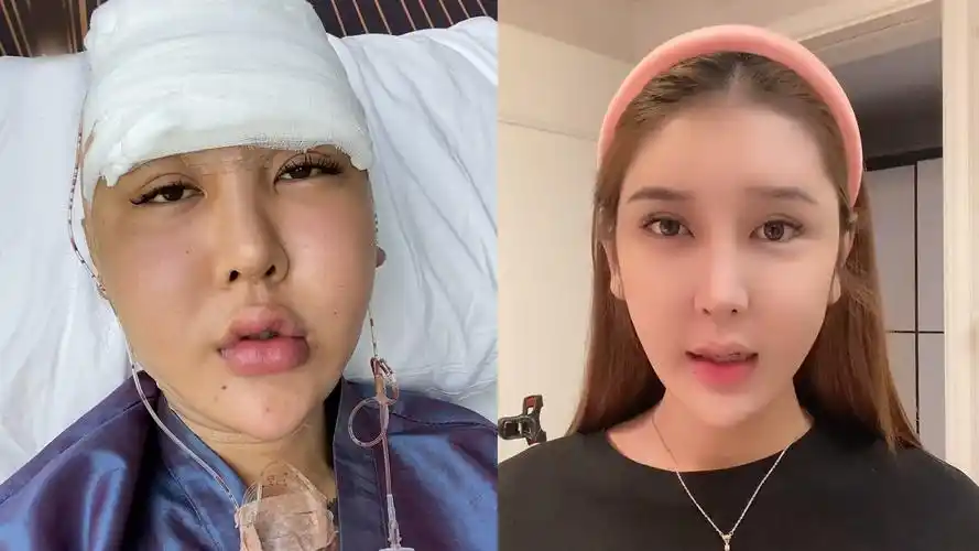 知名女网红整容再失败,鼻青脸肿面目全非,自言200万白花了