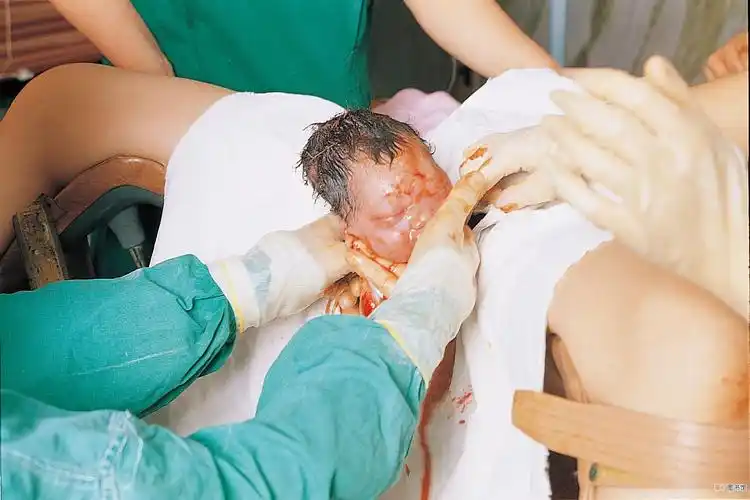 这时要用剪刀剪开会阴,方便孩子娩出 .