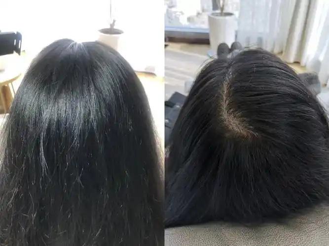 日轻丝增发技术-让头皮头发更年轻化 - 新闻频道 - 中国文化报道网