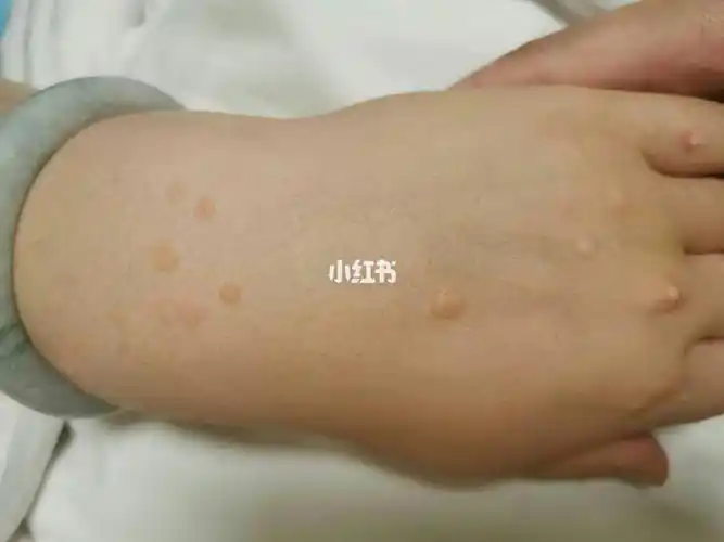 彻底祛除扁平疣,找回自信不是梦