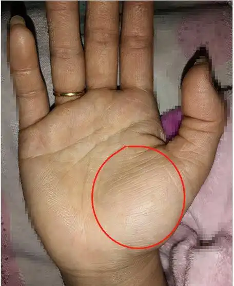 你手上的金星丘如果出现了横纹一定要引起重视特别是女性
