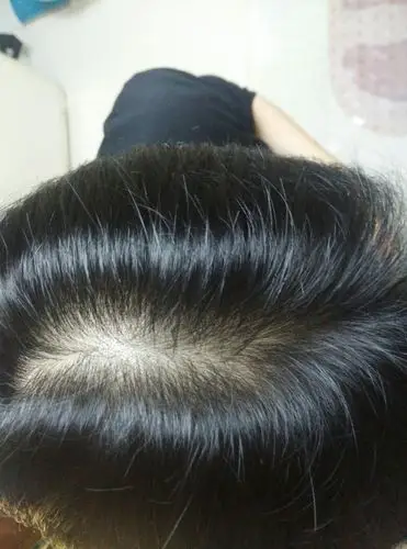 大家帮我看看头发这样正常吗,还是毛囊少?希望认真回答不要乱说谢谢了