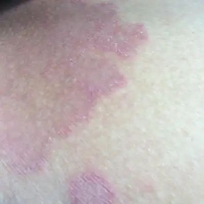 分享几个治疗股癣的方法和经验