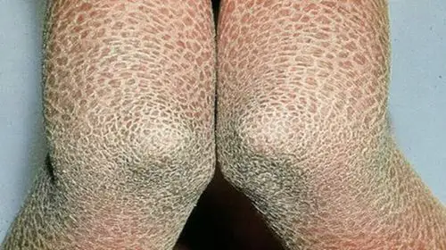 鱼鳞病1岁半婴儿胳膊的症状图片