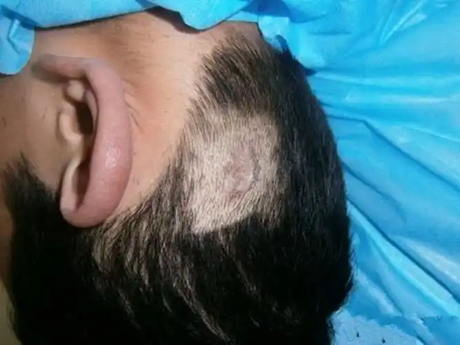 获得性太田痣图片