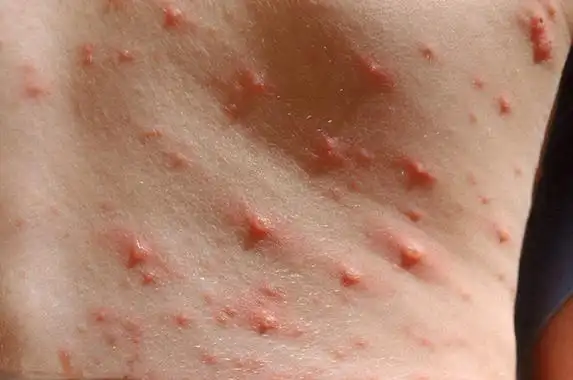 小孩水痘症状图片62