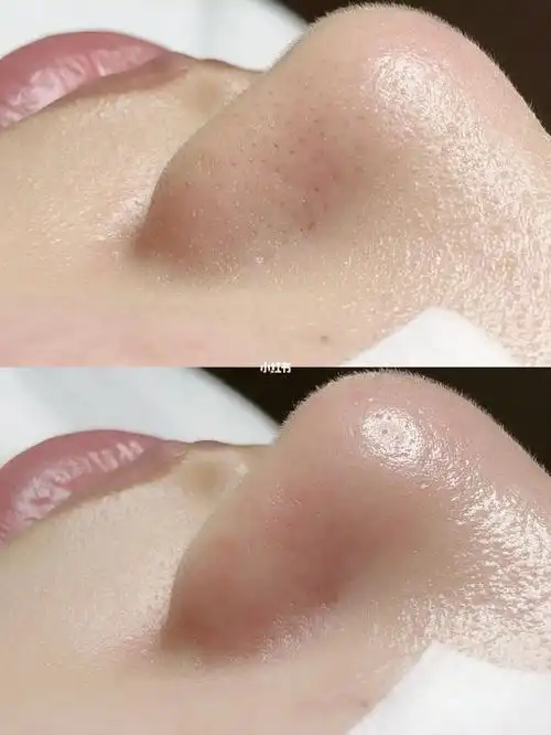 毛孔黑头清洁前后对比