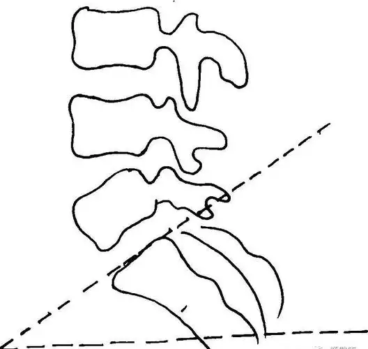 骶骨点头正常情况下腰骶角的正常范围为34°—42°之间,女性的腰骶角