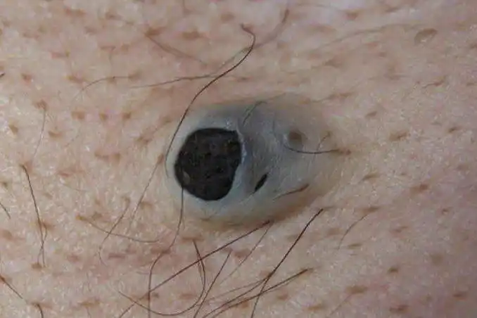 后背毛孔里硬硬的黑刺图片_图文_文章_美咯_让您放心美!