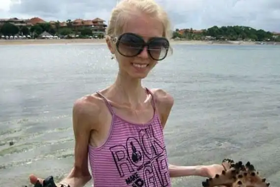 世界上最瘦的女人患厌食症仅重20公斤