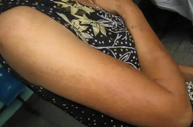 尿毒症是"拖"出来的,皮肤出现这3种症状,可能是肾脏在求救|肾病|治疗