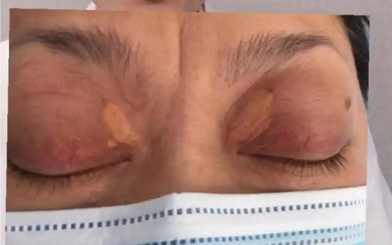 睑黄liu,眼睑黄色斑块_哔哩哔哩_bilibili