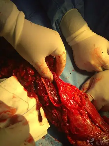 小医-上肢重度脱套伤,反取皮,vsd负压吸引治疗.