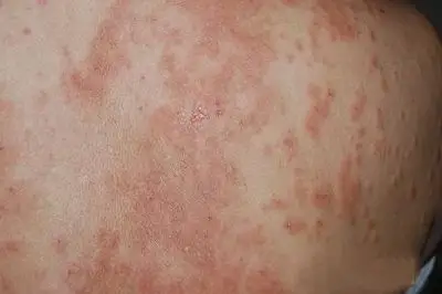 健康热点 疾病 湿疹 急性皮炎湿疹的早期症状 1,自觉灼热及剧烈痛痒.