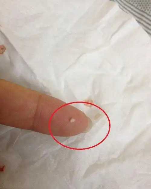 眼角长脂肪粒傻傻用手挤3招轻松去除不留痕很少人知道