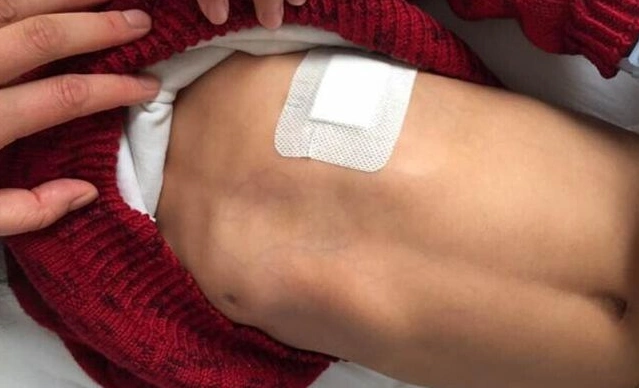 鸡胸问答_鸡胸患者咨询-有来医生