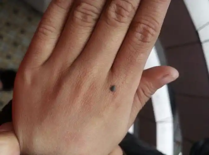 我儿子手背上有颗痣有四五年了该不该去掉了有点黑,以前没有这么黑的