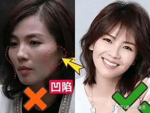 这些你最好了解一下|太阳穴|脸型|面颊|高颧骨|求美者_网易订阅