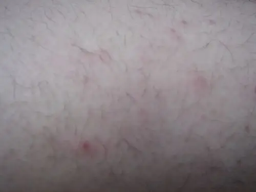 2 2007-06-13 腿上毛囊红肿发炎 2012-01-23 大腿发毛囊发红 1 2009