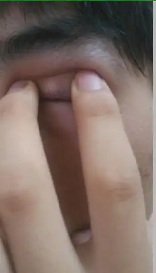 2014-07-08 秦爱洁 医师 眼睛上眼皮里面翻开长了一个浓包.