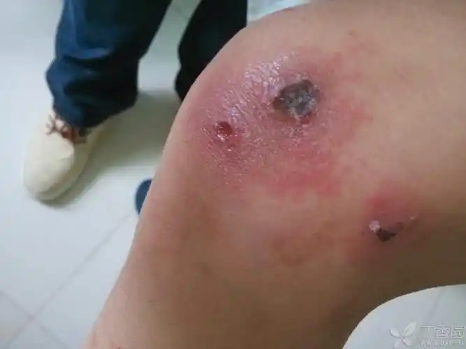 【求助】外伤后皮肤溃疡 - 皮肤与性传播疾病讨论版 -丁香园论坛