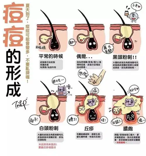 痘痘其实是个文明人的病