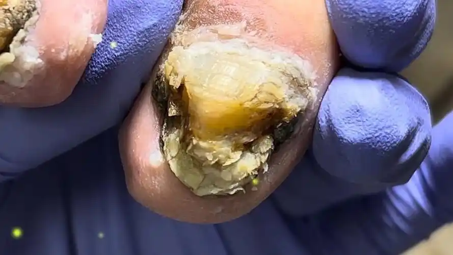 灰指甲拱起像山一样,还有虫子!超级脏