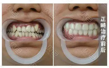 有虎牙需要戴牙套做牙齿矫正吗注意虎牙可能潜伏有隐患