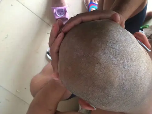 后脑头皮上皮肤出现一块白一块白这是癣吗这是怎么了呢