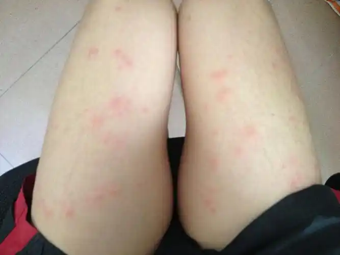 全身起红斑,一片一片的,瘙痒