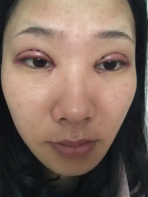 全切双眼皮加开眼角第一天这样的双眼皮恢复好了会好看吗