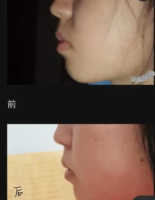 有没有拔牙内收太多嘴瘪的小伙伴啊