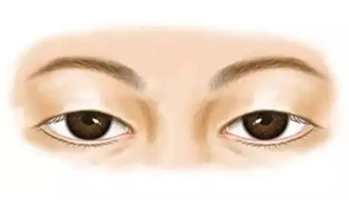 上海做上睑下垂修复手术很好的医生是谁