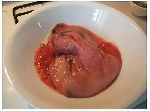 加国卫生部警告:感染风险高,禁售胎盘产品