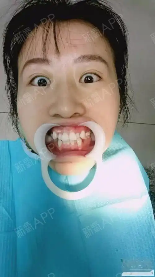 25岁高龄虎牙 牙列拥挤矫正记录