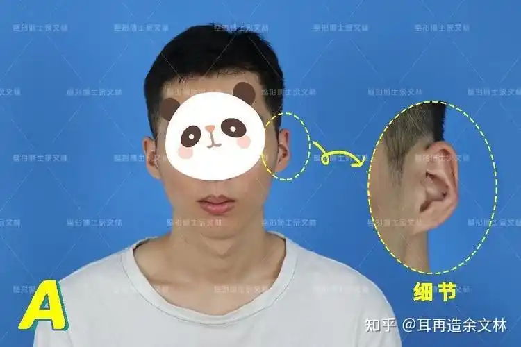 【案例分析】这个反骨耳患者耳骨外翻严重,他觉得不好看做手术修复了