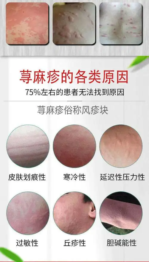 到5%的患者持续6周以上,并且经常出现风疹症状湿疹和荨麻疹都是皮肤病