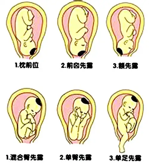 什么是胎方位示意图_有来医生