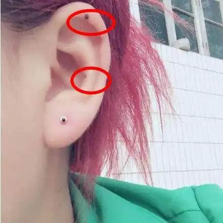 耳朵上有痣图解:耳朵上长痣代表什么好不好