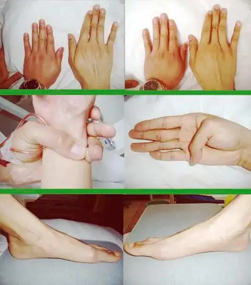 导致非凡天才殒命的危险疾病--马凡氏综合征