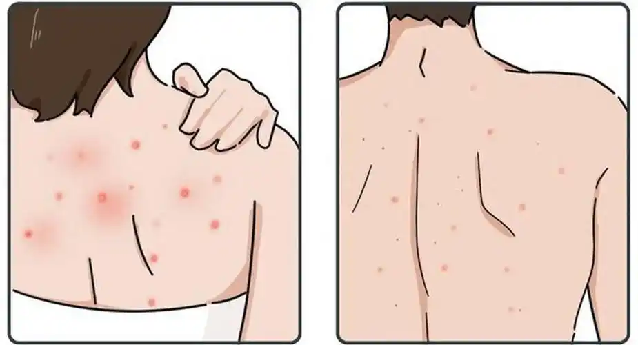 瘙痒?还伴随脱发?毛囊炎在作怪!找出元凶,做好预防